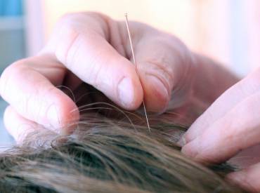 L’Acupuncture, comment ça marche ?